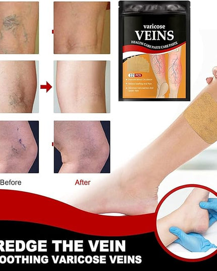 Varicose Veins Treatment Patch,12 PCS Varicose Veins Remover For Legs Patch Spider Veins Removal for Legs Patch