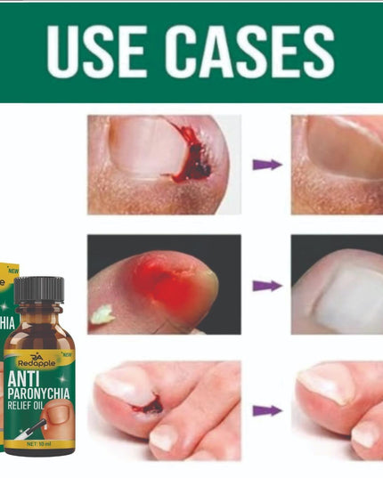 Anti Paronychia Relief Oil 10 ml Pack of 1