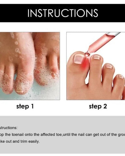 Ingrown Toenail Drops 60 ml Pack of 2