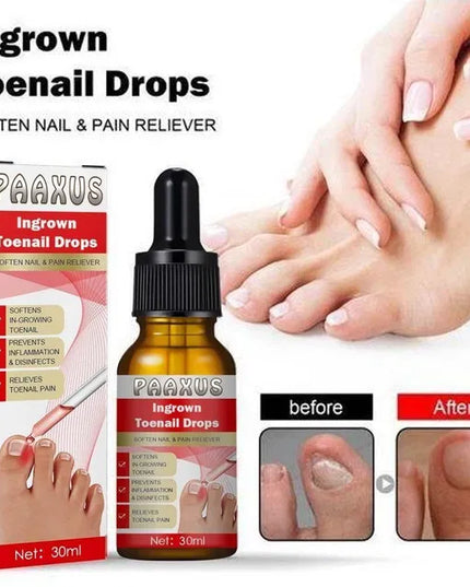 Ingrown Toenail Drops 60 ml Pack of 2