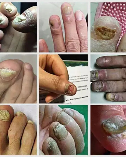 Ingrown Toenail Drops 60 ml Pack of 2